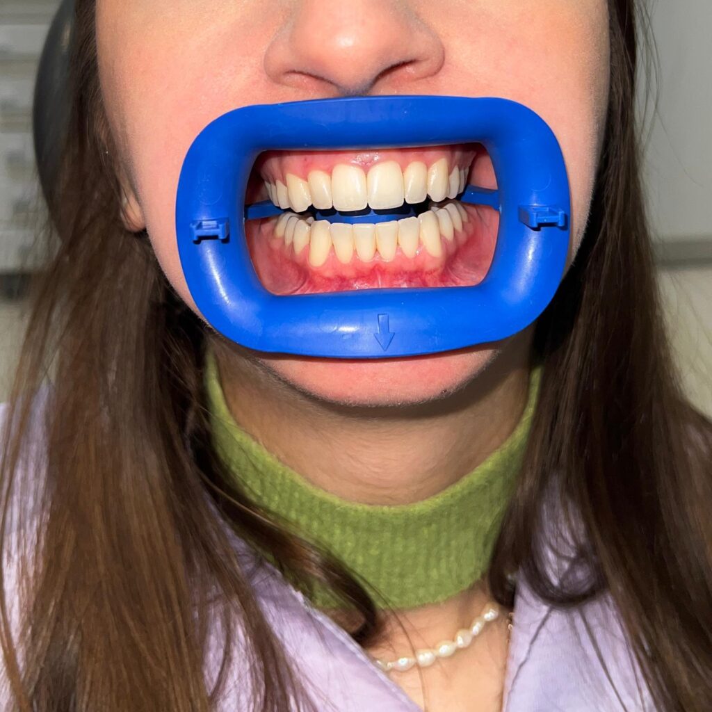 culoarea dintilor naturali intr-un zambet sanatos