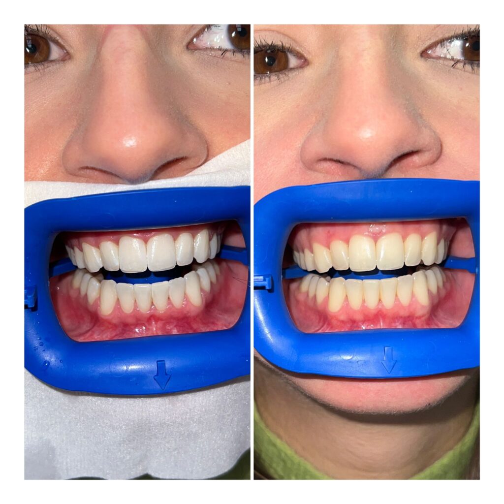 culoarea dintilor inainte si dupa restaurare dentara estetica