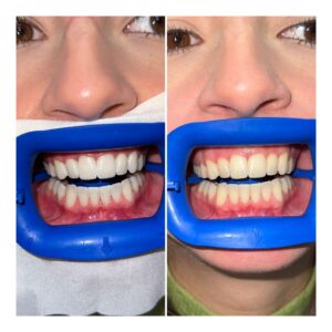 culoarea dintilor inainte si dupa restaurare dentara estetica